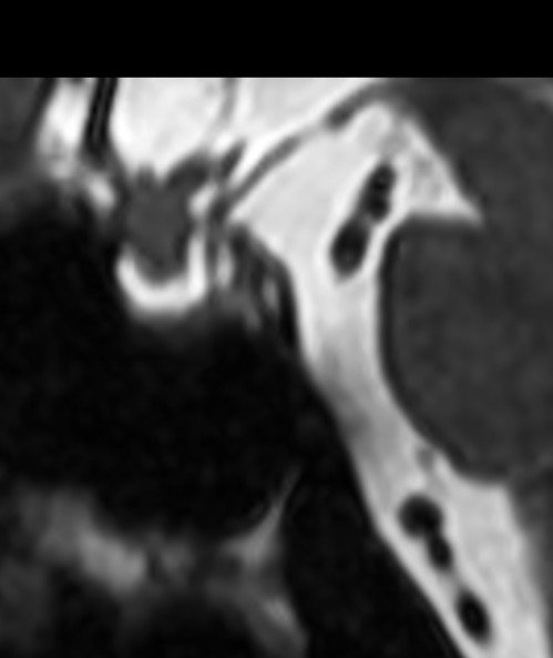 StuckOnASlice's tweet photo. 62Y/F with complaints of right sided facial weakness. No vision complaints. Image: CISS sequence sella focus.

Comment likely organ of origin and possible diagnosis.
#neuroradiology #RadTwitter #radiologyresident https://t.co/Xf4gAgr5eM