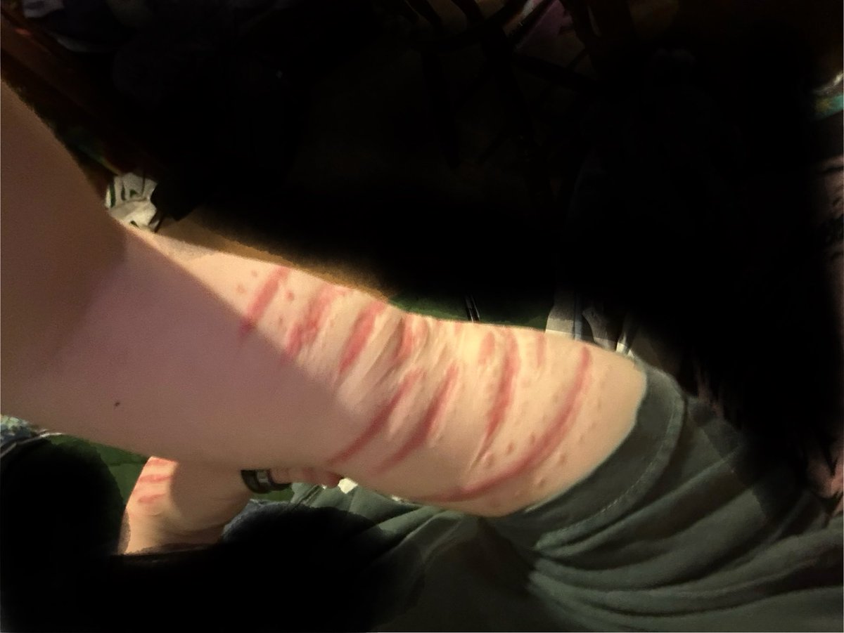 teethareboness's tweet photo. scars from the only time i got medical attention for self harm. stitch scars freaked me out at first but theyve grown on me. ALL SFX, AI, FAKE!! DONT LOOK IF IN RECOVERY!! #slitwt https://t.co/75mS8ONZfU