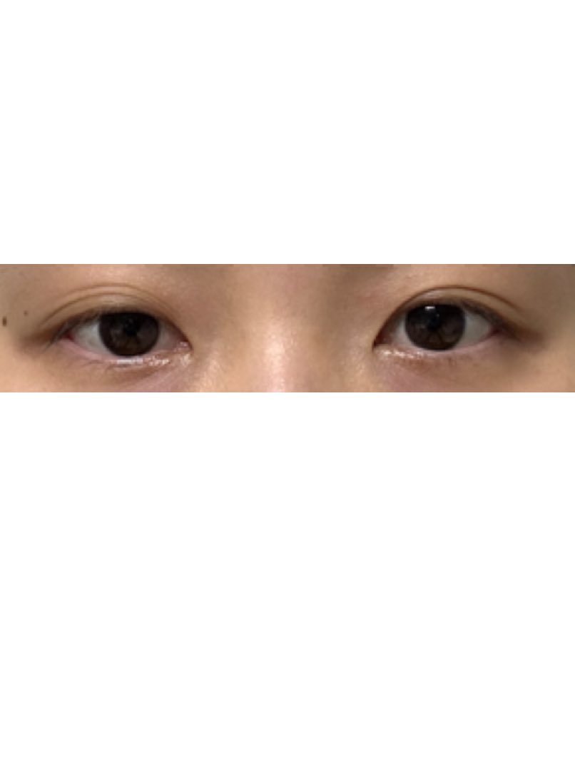 zdtixt58461's tweet photo. #目整形レポ

 2週間目の一番腫れてた時期の写真
左右差すごいし、三重で老眼だったから自然で好き
パッチリ二重は似合わなくて永遠になれないのは悲しいけど、一番似合ってて整形感ないデザインにしてくれて感謝

#韓国整形 #整形垢さんと繋がりたい 
#ルビー美容外科
@rubyps_jp https://t.co/4k7NLlwR5N