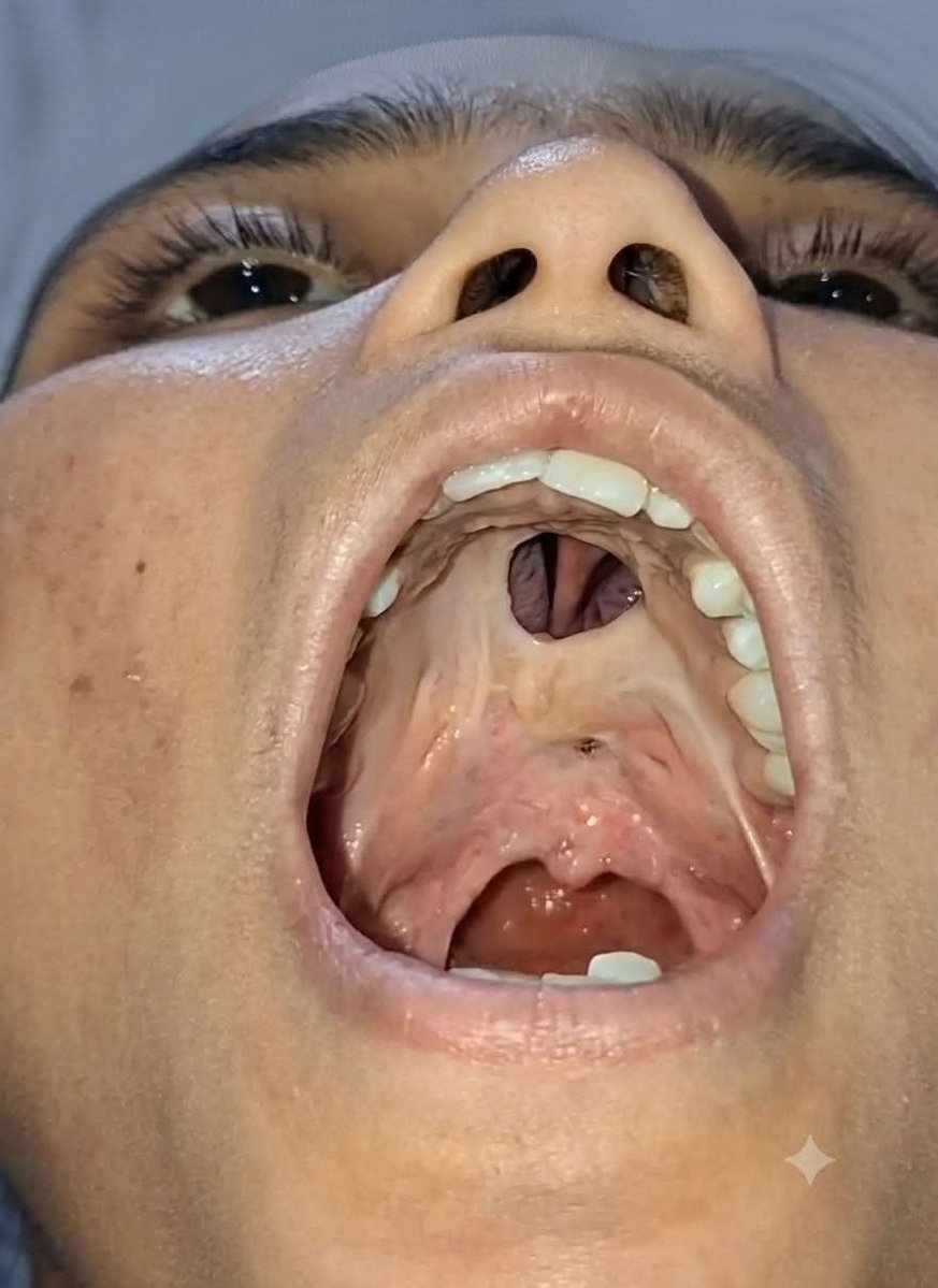 albertoortegana's tweet photo. A 26-year-old woman has had nasal regurgitation of liquids since childhood and hypernasal speech.
Examination shows a well-epithelialized midline defect of the hard palate communicating with the nasal cavity, without signs of inflammation or tissue destruction.
What's the diagnosis? Drop your answer below! 👇