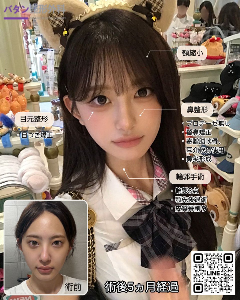 batangjp's tweet photo. 実際バタン美容外科で手術を受けた
全顔モニターモデルの症例をご紹介します💜

✅手術内容
目元整形(目つき矯正)
額縮小
鼻整形(プロテーゼ無し、鷲鼻矯正、寄贈肋軟骨、耳介軟骨移植、鼻尖形成)
輪郭手術(輪郭3点、顎先後退術、皮質骨削り)

┈┈┈┈┈┈┈┈┈┈

📢 ただいまモニターモデル募集中！
気になる方はお公式LINEまでお問い合わせ下さい♪💌

┈┈┈┈┈┈┈┈┈┈

▼お問い合わせ▼
https://t.co/KNCqpIISjz

#バタン美容外科 #韓国整形 #韓国美容 
#額縮小 #額手術 #小顔 #植毛 #ヘアライン矯正
#鼻整形 #鼻手術 #鼻尖形成 #鷲鼻 #鷲鼻矯正
#プロテーゼ無��鼻整形 #輪郭手術 #骨切り #皮質骨削り
#輪郭3点 #顎先後退術 #T字削り #バッカルファット除去
#咬筋縮小 #目元手術 #目つき矯正 #埋没 #全切開