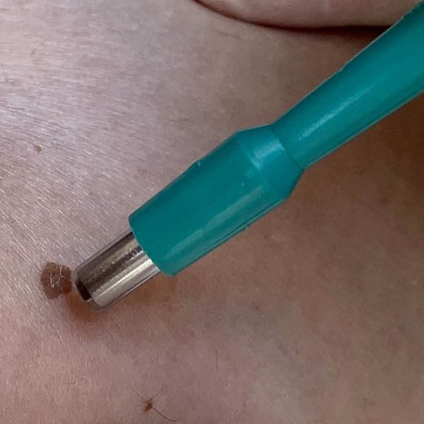 Zharif_Ismail's tweet photo. Harini pun first time buat punch biopsy. Pengalaman baru ☺️ https://t.co/MxwHI2zPNv