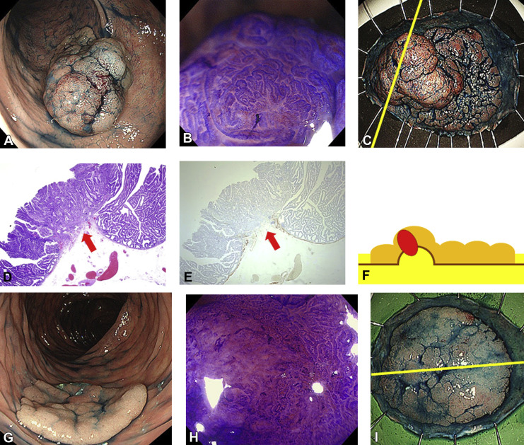 AchintyaSinghMD's tweet photo. Why spend an extra  2 minutes inspecting a polyp before resection?

Because 2 minutes may completely change your treatment plan.

The goal of optical diagnosis isn't simply to identify an adenoma.

It's to answer one question:

Is there submucosal invasion (SMI)?

For any colorectal lesion >10 mm (Paris 0-Is or 0-IIa/IIb), think Lateral Spreading Tumor (LST).

Why? https://t.co/xOsFg7be0x

🟢 LST-G homogeneous → 0.8% SMI

🟡 LST-Non Granular flat → 8% SMI

🔴 LST-Non Granular pseudodepressed → 42.5% SMI

The closer you look, the better you stage.

The better you stage, the better you treat.
