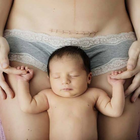 GustavoAdolf_'s tweet photo. Hay quienes, desde el desconocimiento, cometen el error de restar valor al milagro de un nacimiento por cesárea, sin embargo, es infinitamente más sublime. 
Una mujer que pare por cesárea es partida prácticamente en dos y cortadas sus entrañas para rescatar un ángel. Sus dolores son intensos durante días y sus riesgos son mayores a los de un parto normal. Muchas mujeres mueren cada año en su intento de dar vida. 
Felicidades a todas las madres que llevan esa cicatriz, que demuestra que lucharon y vencieron a la muerte dando vida.❤️🦋