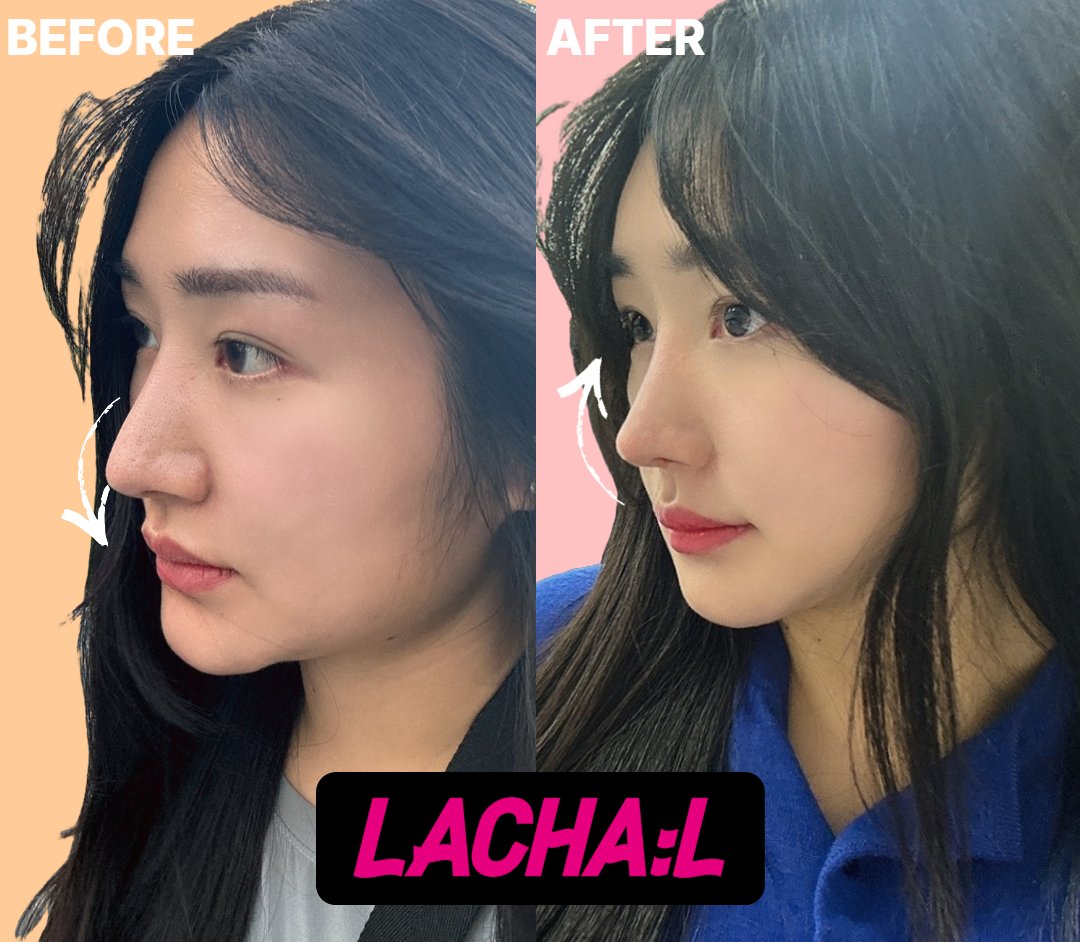 Lachal_JP's tweet photo. この方は鼻の手術を受けてから6ヶ月で再手術を希望してラチェルを訪れてくださいました。
鼻の再手術、小鼻縮小、鼻先
整形で自信もアップ！
美しい鼻になって本当に満足しているそうです～

申し込みはこちらえ！
🔻🔻🔻
https://t.co/ge1ugwXO1Z https://t.co/i5HRCZoRuG