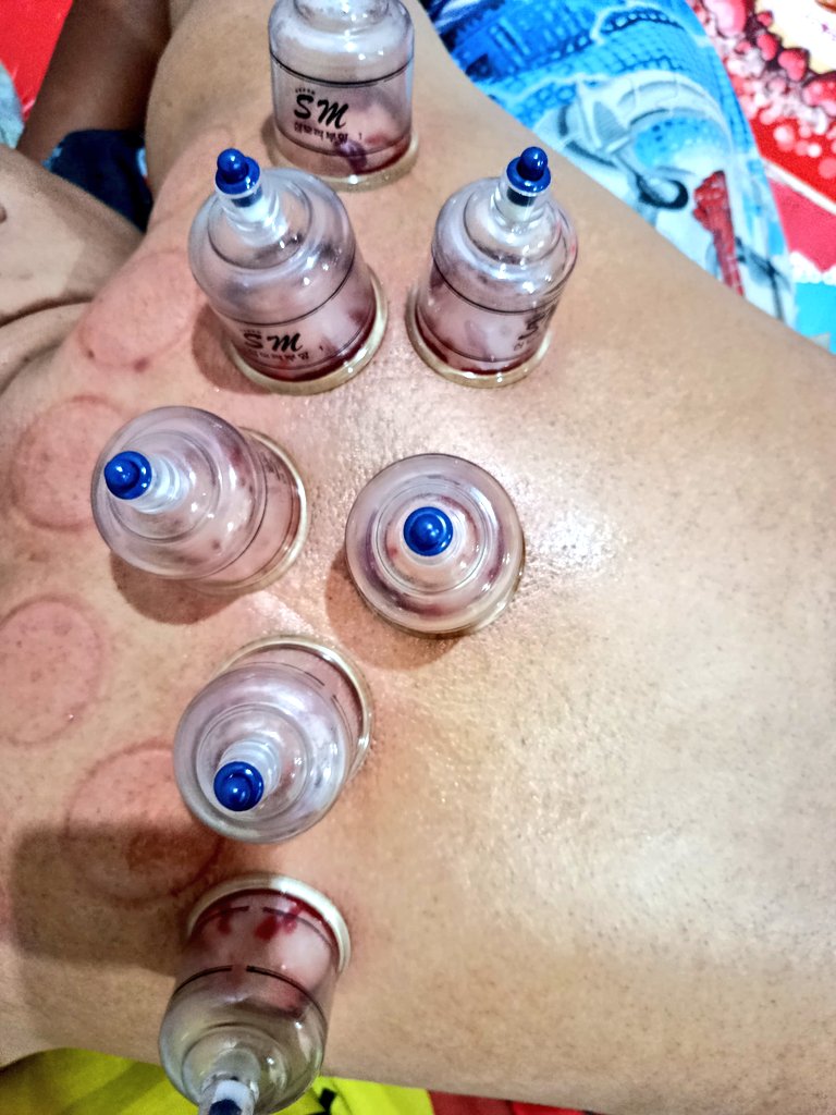 komputerr99's tweet photo. Langsung entenggg, ngantuk ilang, segerrrr luar dalm.
Bekam punggung, lengan, pinggang.
Bekam kaki, tangan
🙏 belum berani bekam area kepala,
asline pengen tapi horror 😰😨
#bekam #terapi #alternatif #bekambasah #buangracun https://t.co/c0XveW91Ou