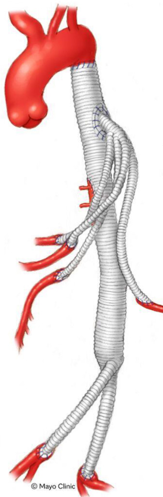 MayoClinicCVS's tweet photo. In this #JVS study, A. Pochettino, MD et al, share long-term outcomes of open thoracoabdominal aortic repair in connective tissue disease patients.
https://t.co/borWqOmZGk https://t.co/QPxaJ7HIfj