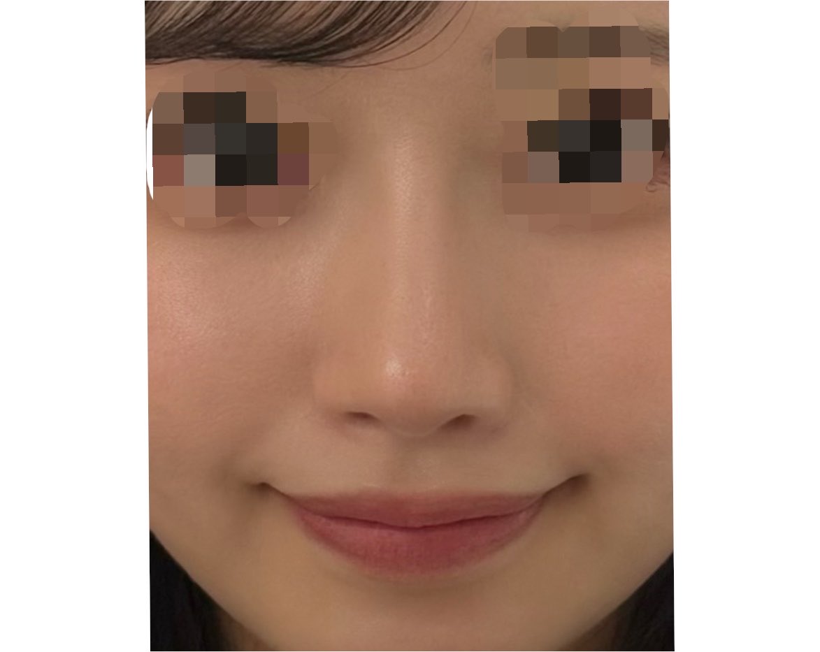 picvlvna__a's tweet photo. 何気なく撮った顔見たら鼻めちゃ綺麗だったから見て‼️
横顔も好きだけど正面はコンパクトな忘れ鼻で気に入ってる https://t.co/BXbwUKkjyV
