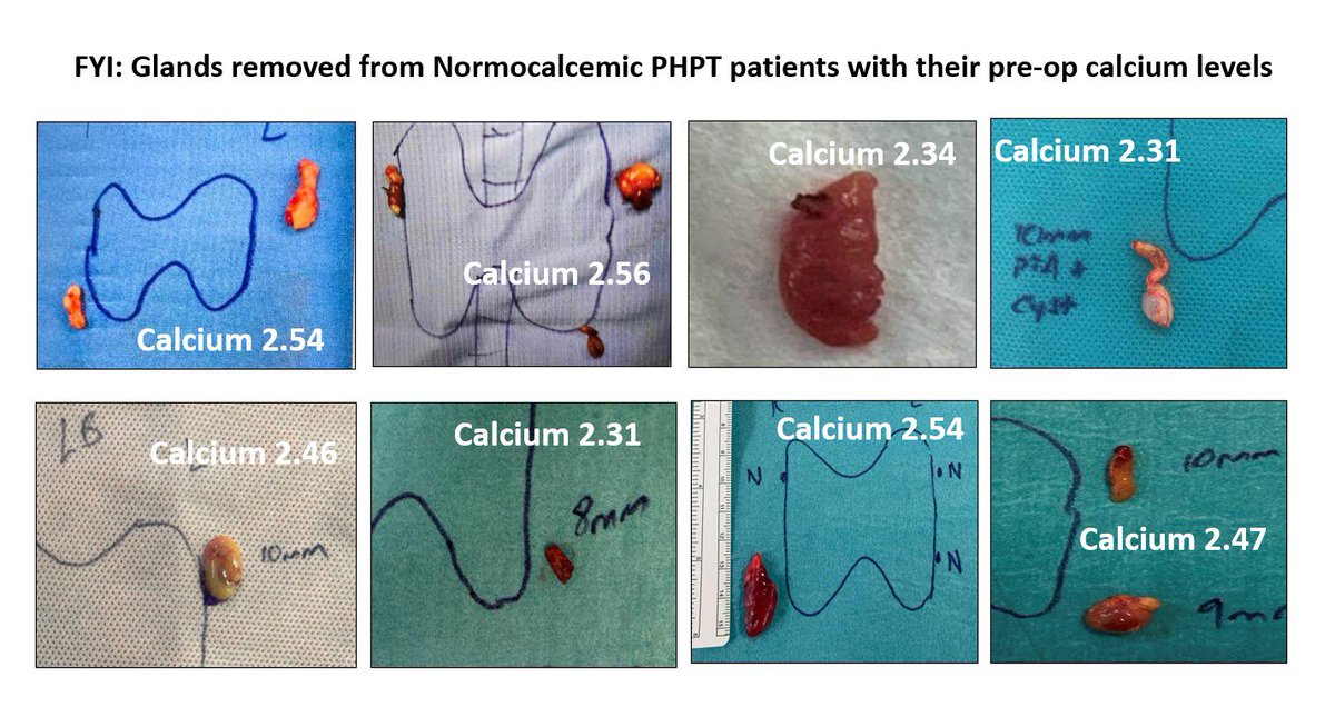 SpSallie's tweet photo. A current survey: #endocrinology patient experience #Hyperparathyroidism Results so far 164; 
62: Very positive. 
61: Endured Watch &amp; Wait gatekeepers. 
35: Bypassed endos, straight to surgeons. 
6: Refused appointments with calcium <2.85
Watch &amp; Wait lasts years &amp; destroys lives https://t.co/qY748HnxLG