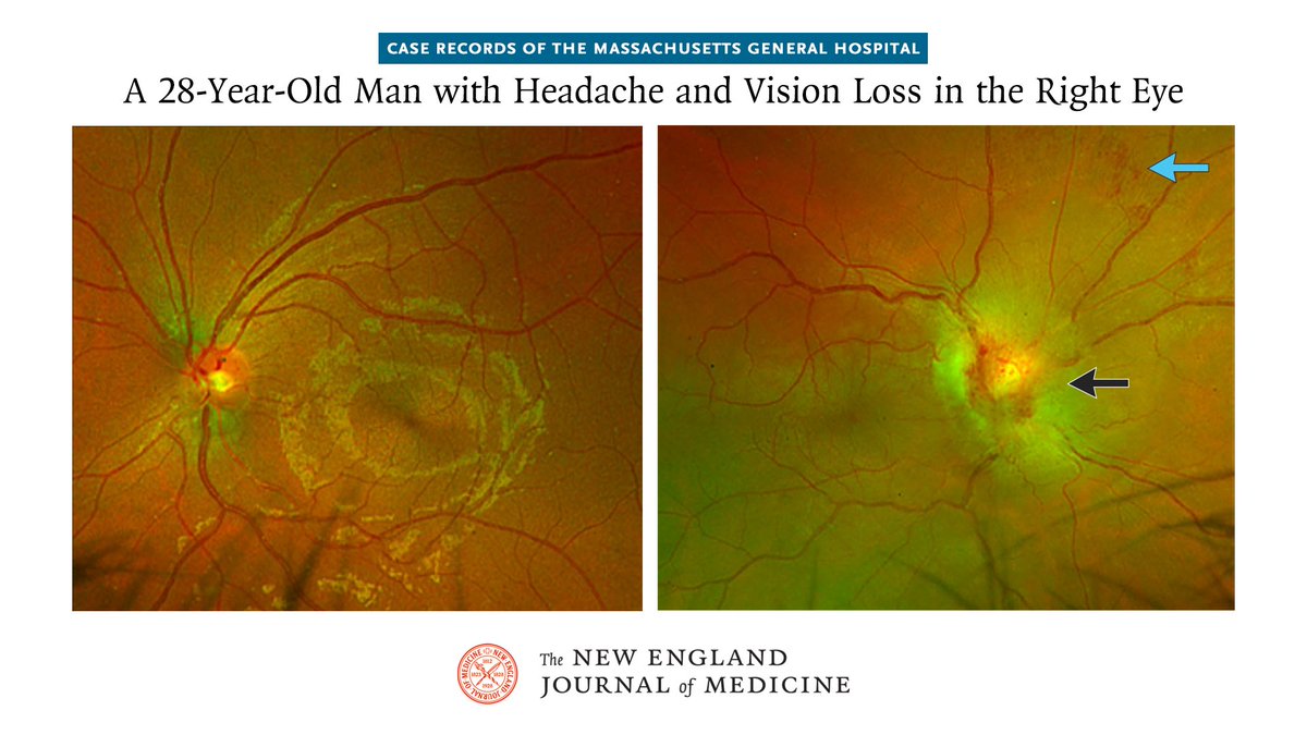 NEJM's tweet photo. Case Records of the Massachusetts General Hospital (@MassGeneralNews): A 28-year-old man was admitted to the hospital for a headache and vision loss in the right eye. 👉 https://t.co/3JNnsHzE4l 

Slit-lamp examination of the eyes showed mild periorbital erythema of the right eye, clear corneas, and normal ocular adnexa, conjunctivae, and sclerae. The anterior chambers, irises, lenses, and vitreous bodies were normal in both eyes. The left optic nerve was normal (Panel A). Examination of the right optic nerve (Panel B) showed optic disk edema equivalent to grade 5 on the Frisén scale (which ranges from grade 0 [normal, no optic disk edema] to grade 5 [severe, circumferential optic disk edema with obscuration of all vessels]) with the presence of macular and subretinal fluid extending circumferentially 1 disk diameter from the optic disk. The vessels appeared normal in both eyes. The extraocular movements were full, without pain or nystagmus. Optical coherence tomography showed optic disk edema in the right eye, along with subretinal fluid. 

Read the full case details in “A 28-Year-Old Man with Headache and Vision Loss in the Right Eye,” a Case Record of the Massachusetts General Hospital, by A.L. Gilbert et al.: https://t.co/3JNnsHzE4l