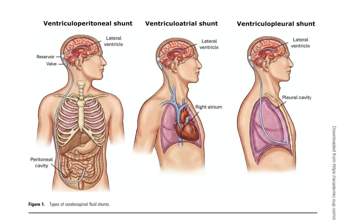ABsteward's tweet photo. Wow, this is the review article I’ve been waiting for!
🆕🔥🟢State-of-the-Art Review: Infections in Patients With Cerebrospinal Fluid (CSF) Shunts #idxposts #bookmark https://t.co/63hVilBXlY https://t.co/SgALye8iQk