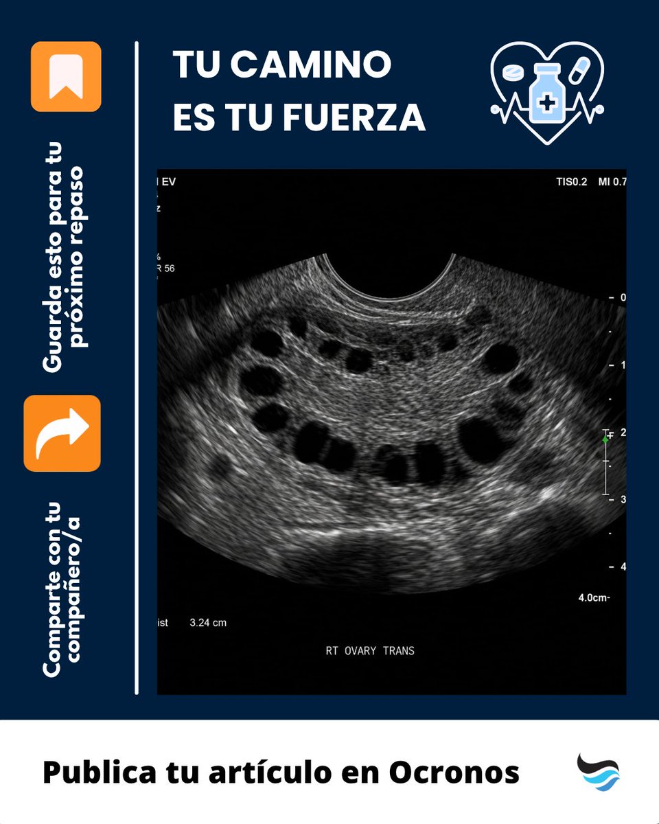 revistaocronos's tweet photo. Síndrome de ovario poliquístico: no todo está en la ecografía.
Oligomenorrea e hiperandrogenismo pesan más que el ovario con múltiples folículos.
Guárdalo para evitar sobrediagnóstico. 🧠 #Ginecología #Medicina https://t.co/mOEkKTgb0N