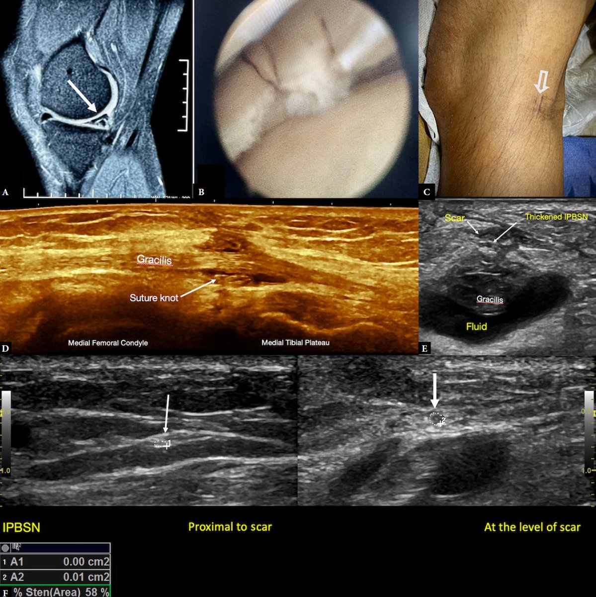 Rheumatology's tweet photo. Genicular nerves: ultrasound anatomy, scanning techniques, and clinical implications
FREE PDF
https://t.co/WOtO37AJZB https://t.co/naP1WCAOwN