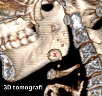 dratilla's tweet photo. 16 mm’lik dev submandibular tükürük bezi taşı.
İlk seansta kanalın aşırı dar olması nedeniyle daha fazla travmaya yol açmamak için işlemi sonlandırıp stent yerleştirdim.
İkinci seansta kalan taş parçalarını çıkararak tükürük bezini koruduk.
#Sialendoskopi #KBB #TükürükBeziTaşı https://t.co/kyrvymXgQX