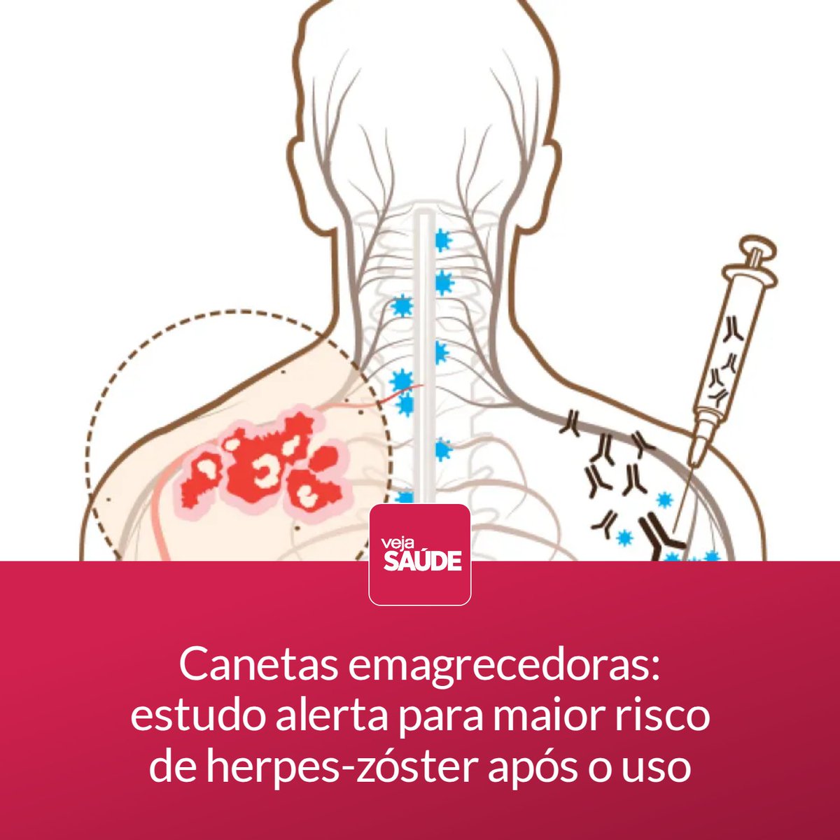 VejaSaude's tweet photo. Pesquisa revela que certas pessoas são mais propensas à reativação do vírus da catapora e a casos de herpes com o tratamento, mas há estratégias preventivas

Leia mais em:
https://t.co/A72hxMKLyH https://t.co/4FyajuEgI9