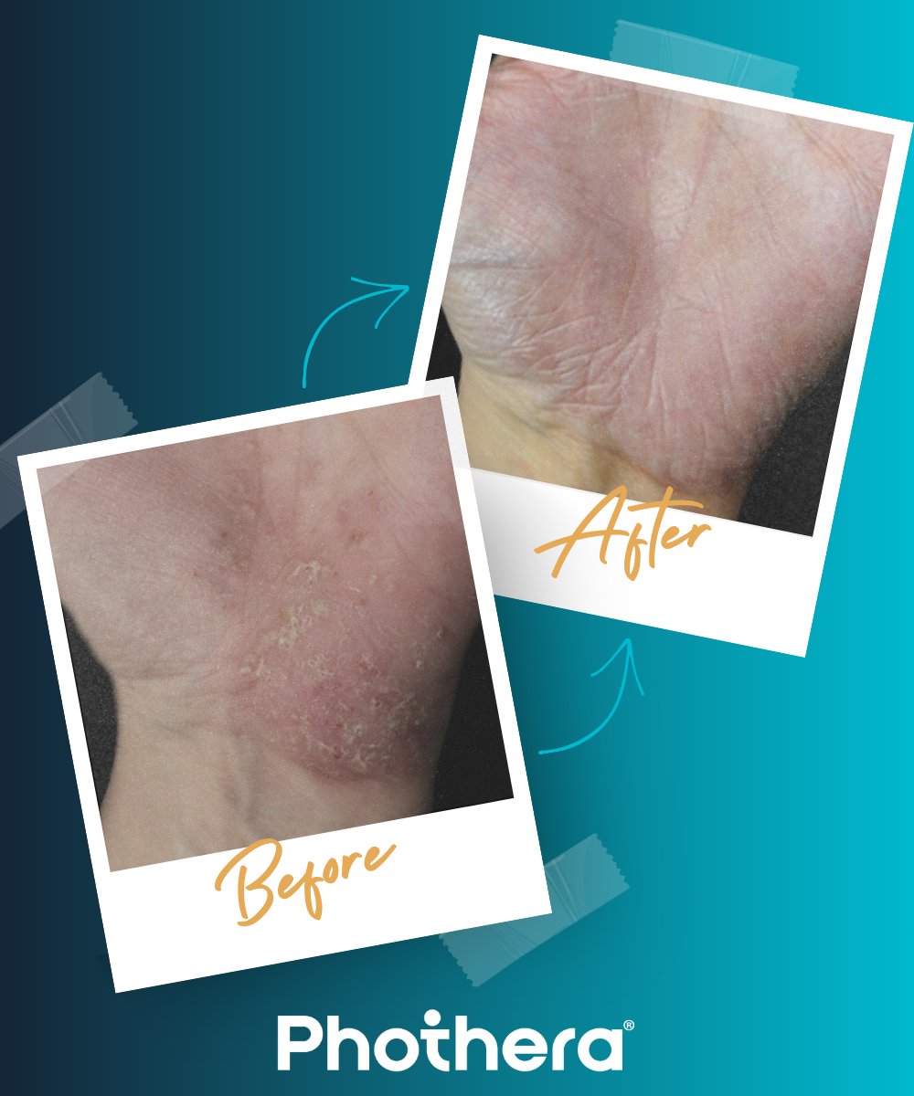 Phothera1's tweet photo. Living with flares, creams, and side effects can feel exhausting. Phothera is a different option for people with #psoriasis — safe for children and during pregnancy and backed by clinical evidence. No harsh drugs. Just real, visible results.

See results: https://t.co/hjlauZl2De https://t.co/rl6EpPi0m3