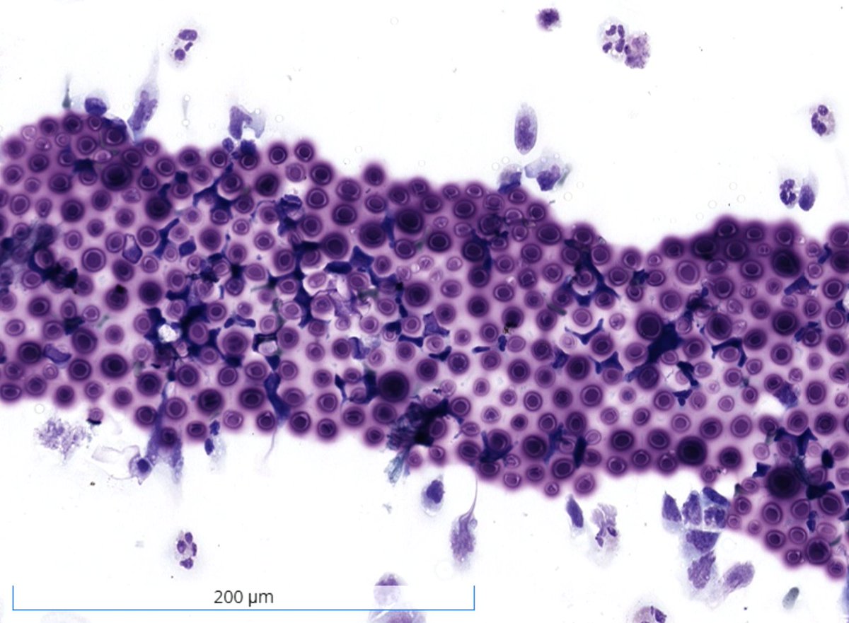 sza_jhcyto's tweet photo. "A soccer ball in the CSF - except this goal belongs to Cryptococcus." https://t.co/JnlxKI9VRI