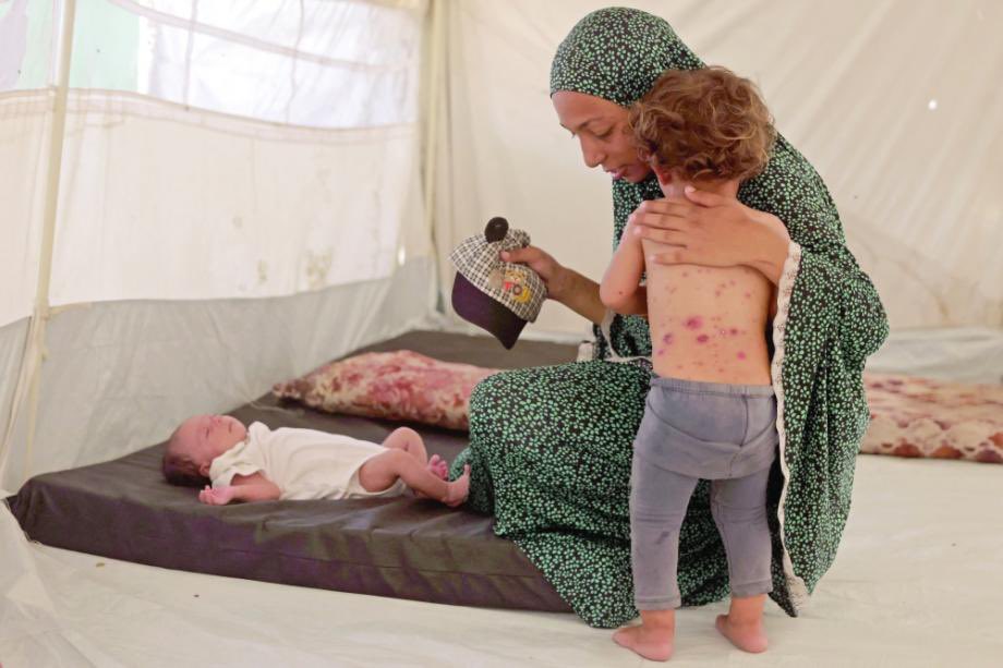 DropSiteNews's tweet photo. Gaza’s Health Ministry says more than 53,000 chickenpox cases have been recorded since the start of the year, warning that the surge is “record-breaking and alarming” and signals a dangerous loss of epidemic control.

Health official Zaher al-Wahidi said infections are spreading rapidly through displacement camps with little access to treatment or basic health protections. Severe overcrowding, shortages of clean water, collapsing sanitation, weak vaccination coverage and the breakdown of primary health care are accelerating transmission among children and adults.

Photo: Felesteen Online