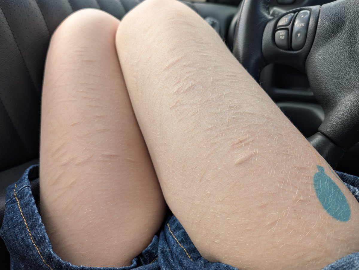 RenAteMyHeartXo's tweet photo. i know my thighs are big asf but look at my scars https://t.co/ljpKRGVB8Q