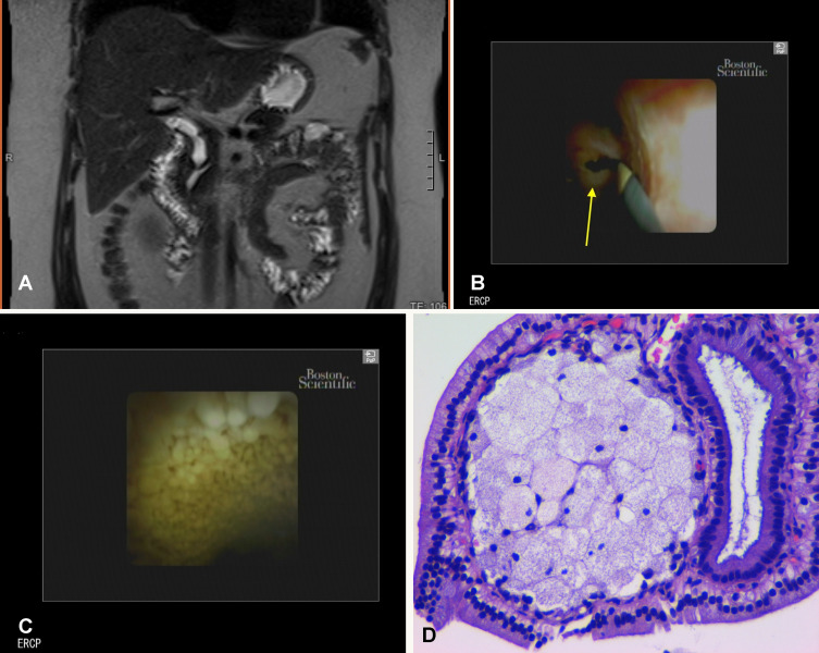 GIE_Journal's tweet photo. At the Focal Point, Nawlo et al find "Cholesterosis beyond the gallbladder: a rare case of common bile duct involvement associated with pancreaticobiliary malunion." https://t.co/Dqc5eKNh6r

#GITwitter https://t.co/ALRHINhnA5