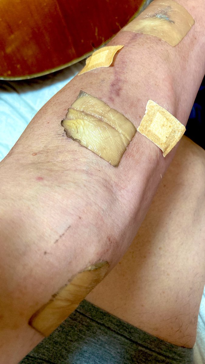 kaz6thlife's tweet photo. ãMy #dialysis #simptom's memo.ïŒ my #lifeã
ððž
âšâ«âšð¹âšðŒâšðºâš
guitar匟ããªãã»ã»ã»ããè¡ç®¡ãéããªããã°â¥ðð§ https://t.co/ZkrdVjtADp