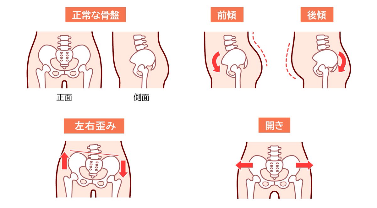 ILC_Osaka's tweet photo. 腰痛には骨盤の歪みも関係することがあります。骨盤が歪んでいると、肩こり・冷え性・むくみ等にもなりやすいです。
骨盤の歪みの改善には正しい姿勢を意識し、ストレッチを行うことが大事です。
#腰痛 でお悩みの場合は一度当院での診察を受けることをご検討ください。
#ILC国際腰痛クリニック大阪 https://t.co/s26HVxkrBu
