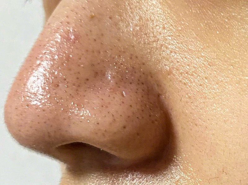 pulunnn's tweet photo. ｺﾘちなみに、皮脂も出なくなるから角栓も詰まり毛穴も改善される。嫌なベタつきなくなってメイクも盛れる😌 https://t.co/AzaEbSTN0z