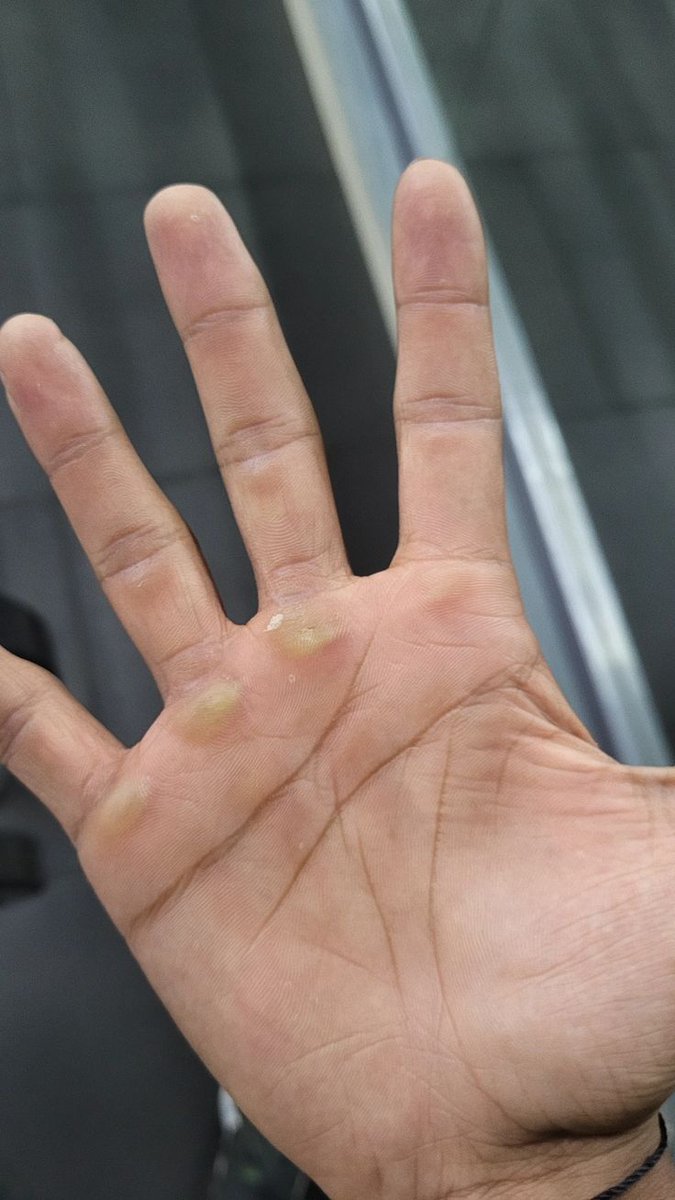 Whoiamyours's tweet photo. Hey @grok , what exactly are these bumps on my brother's hand? Are they a sign of something, or completely normal? https://t.co/WcUvyDWXqq