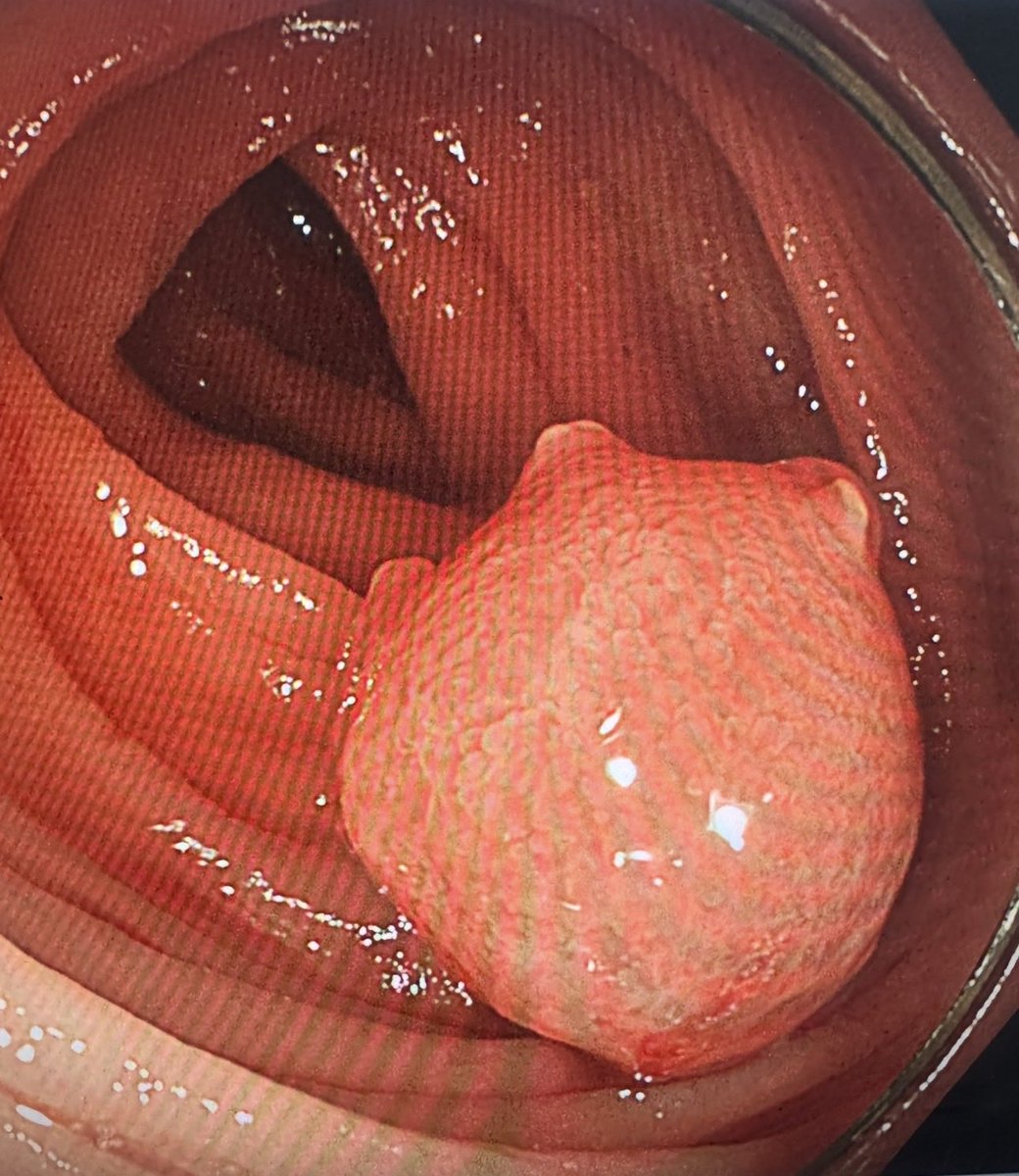 drtelal's tweet photo. This was referred for removal from the transverse, after re-assessing and lifting below, how would you proceed in this 80s male with IDA?
#Endoscopy #GITwitter https://t.co/9qJwVh3Tab
