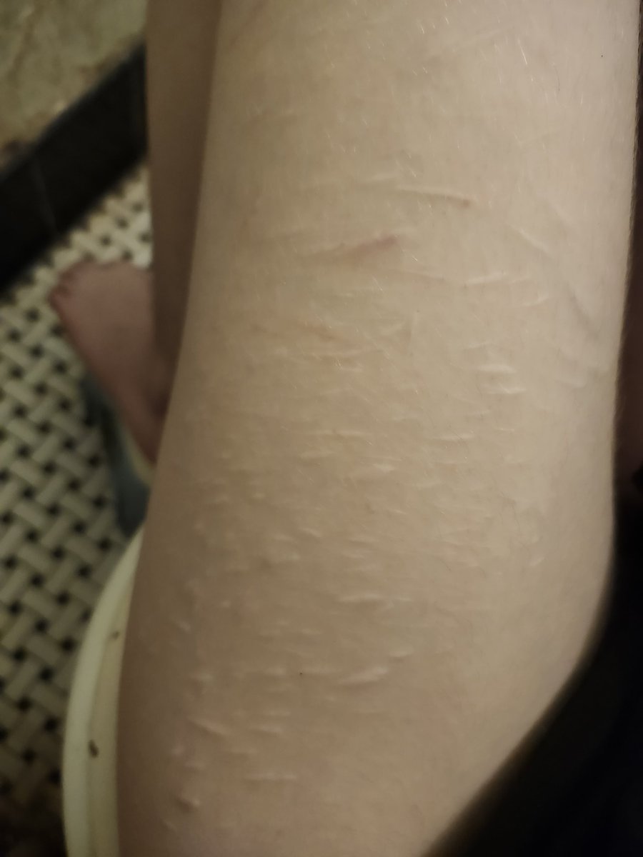 soapcuttingasmr's tweet photo. TW AI STAGE MAKEUP

thigh scar check cause im stuck on tha toilet https://t.co/znkpC2IqdF