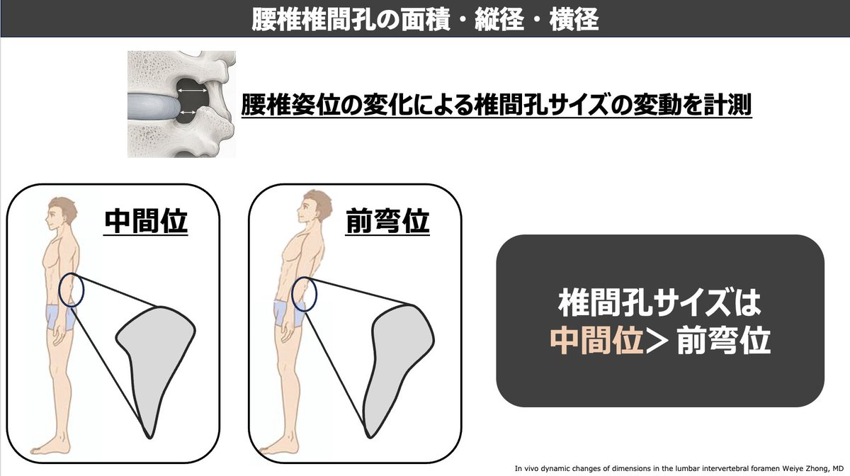 mori_pt_gbc's tweet photo. 腰椎椎間孔の断面積の報告をまとめました。
腰椎の前弯、後弯、中間、側屈、回旋位についてです。
椎間孔狭窄の治療の一助になれば幸いです。             

セミナー参加はこちらから     
https://t.co/m6jgBd9tY4 https://t.co/SVUCYaA5t5