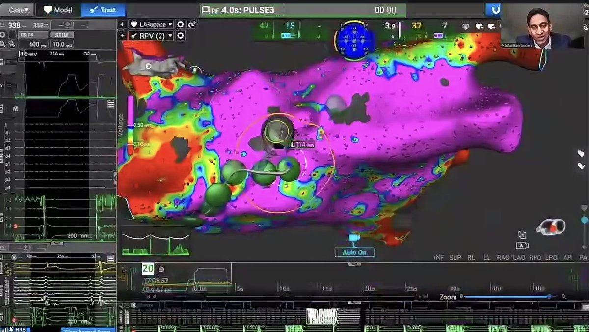 DCR_Dr's tweet photo. Always amazing listening to @PrashSanders 
This time talking on Non-PV isolation in Persistent Afib. Thanks from Indian Heart Rhythm Society
#afib #epeeps https://t.co/mwEEJsaPLR