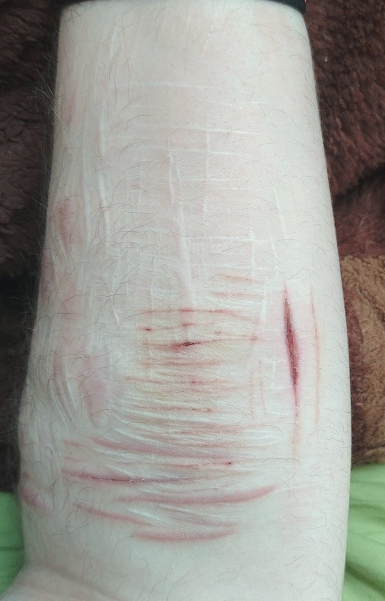aiden_it7's tweet photo. Left arm - this was always my arm with the most scarring but I've been trying to even it out with my right arm https://t.co/XAVJqa6HVm