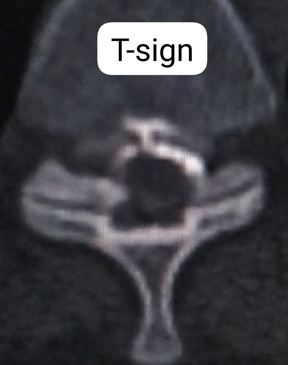 SharathKumarGG7's tweet photo. Exciting diagnostic development in spinal imaging! 🧠🔍
Introducing the **"T-sign"** on axial ultrafast dynamic CT myelography. This novel radiological sign provides direct, definitive evidence of a dural tear in Type 1A spinal CSF leaks, allowing for precise localization and more targeted interventions.
@spinalCSFleak
#Neuroradiology #SpinalCSFLeak #CTMyelography #NeuroIntervention #MedicalImaging