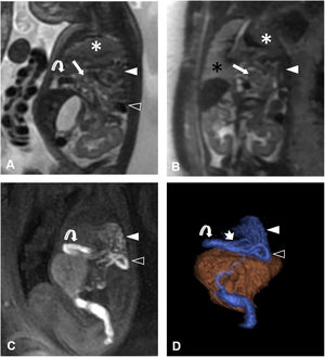 RevistaRADIOLO2's tweet photo. Descubre toda la patología cardiotorácica fetal en este interesante artículo de la serie "RM fetal" que se está publicando a lo largo del año. ¡Descúbrela!
https://t.co/qUtzV1T22f
English: https://t.co/mMZyorPWNA https://t.co/TKjcJhPrt0