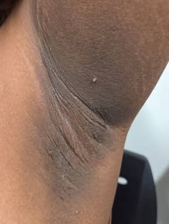 uaivito's tweet photo. alguém sabe o que significa essas manchas escuras no pescoço e nas axilas? isso é normal ou pode ser algo sério? https://t.co/MTolnTGCJB