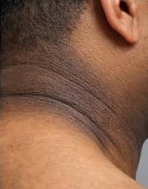 uaivito's tweet photo. alguém sabe o que significa essas manchas escuras no pescoço e nas axilas? isso é normal ou pode ser algo sério? https://t.co/MTolnTGCJB