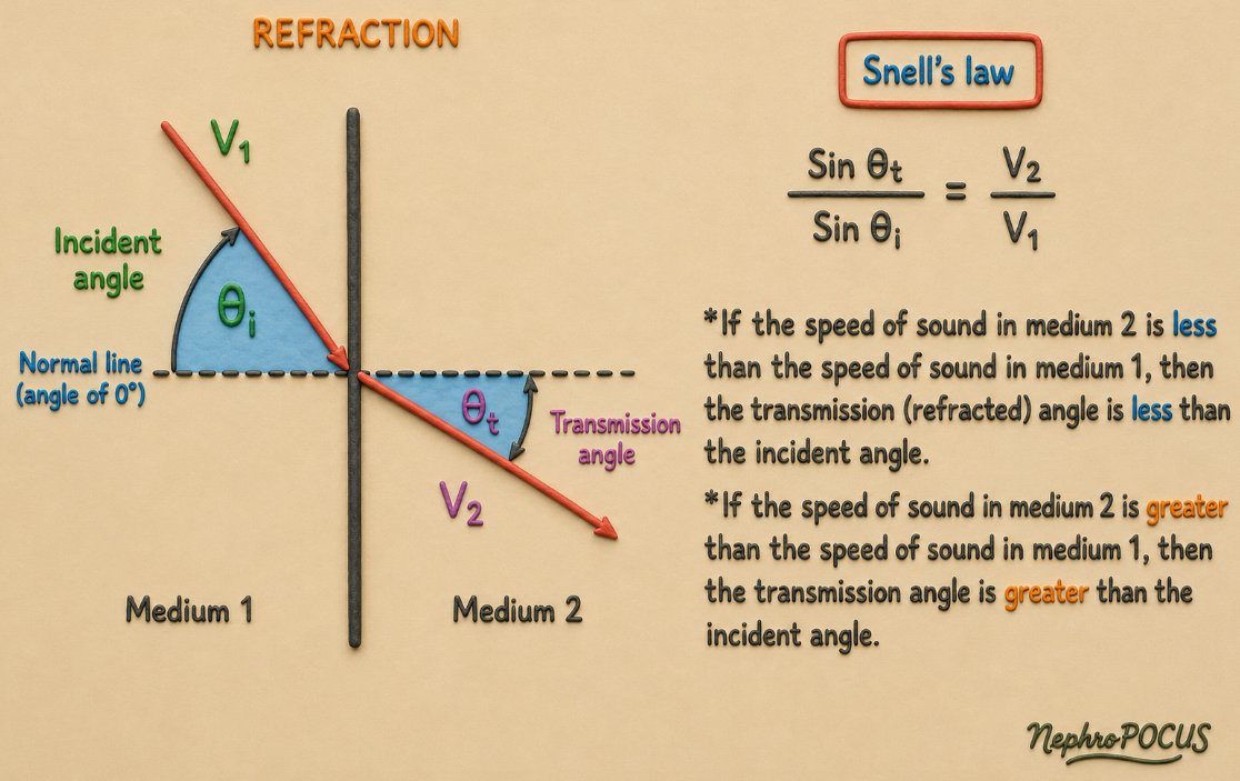 NephroP's tweet photo. Another potentially testable concept on #echoboards - Snell's law
⭕️Snell's law describes how an ultrasound beam changes direction (refracts) when it crosses a boundary between two tissues with different propagation velocities.
sinθt/sinθi = V2/V1
θi - angle of the incoming beam (angle of incidence)
θt - angle of the transmitted beam (angle of refraction)
V2 - speed of sound in the second tissue
V1 - speed of sound in the first tissue (incident)
🌟Both angles are measured from the perpendicular (normal) to the tissue boundary, not from the boundary itself. *Very important to understand‼️*
🎯 Board pearl - If the speed of sound in medium 2 is less than the speed of sound in medium 1, then the transmission (refracted) angle is less than the incident angle and vice versa.
*Since it violates the machine's assumption that ultrasound travels in a straight line, refraction may result in artifacts (e.g., second copy of a true reflector).
