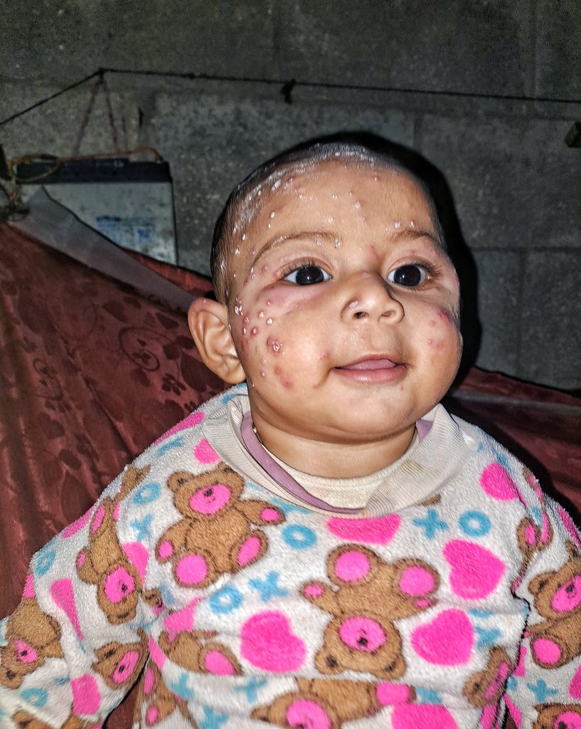 mahmoud60013's tweet photo. Tasneem is the most precious thing I own. The skin disease has spread, covering larger portions of her small body, reaching her face and eyes. Her eyes are swollen and red, and every tear she sheds only increases her pain and distress. The burning sensation is constant, and the intense itching prevents her from sleeping or finding any comfort. Doctors have confirmed that her condition requires urgent treatment. 
https://t.co/Q1uKW9Bwij
Please help us, even with a prayer in the Comments. Even if the comment is a dot