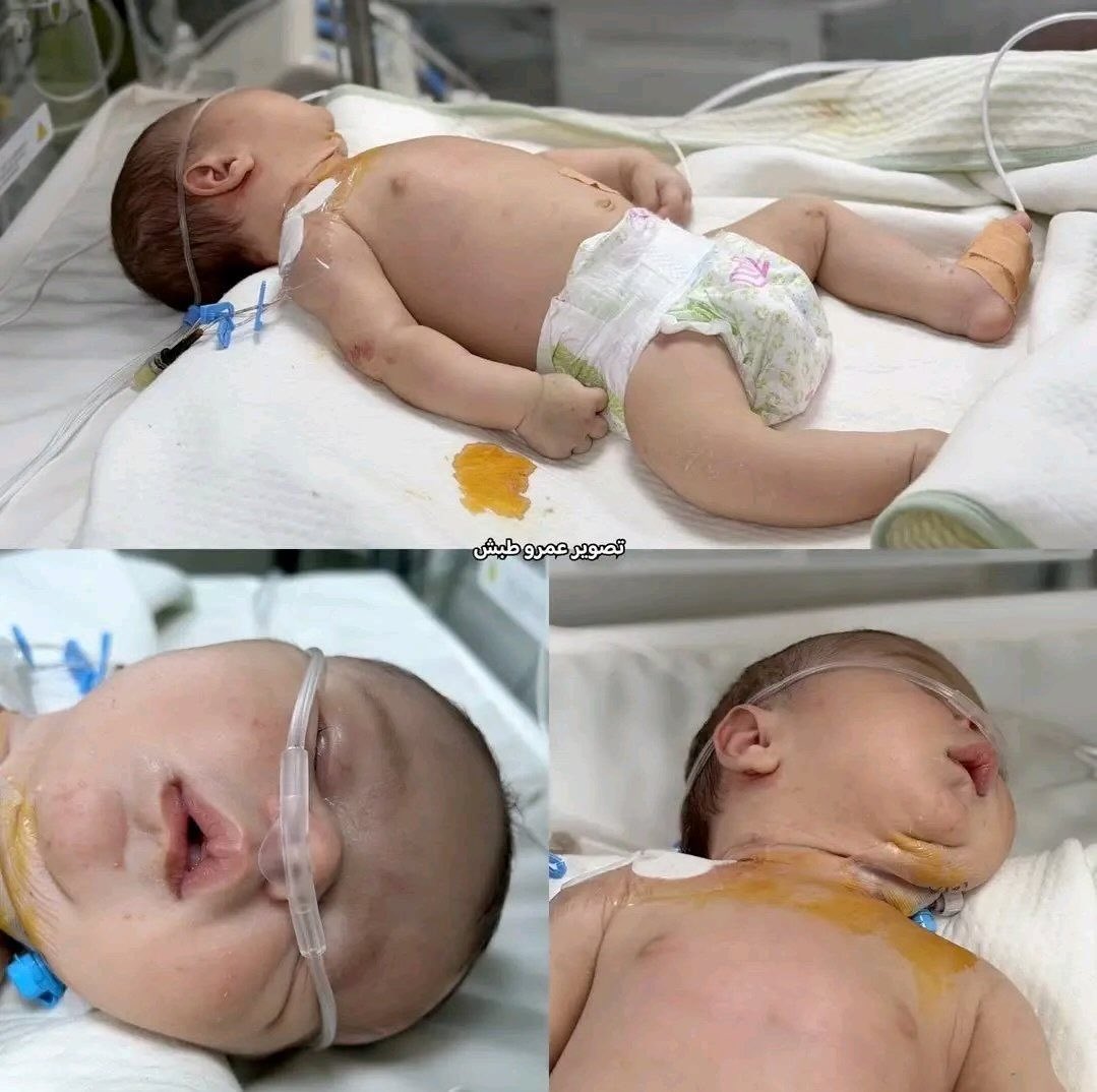 GazaMartyrs's tweet photo. Baby girl Balsam Hassoum Issa passed away from a congenital heart issue after the occupation didn't allow her travel for medical treatment. Due to continued Israeli blockade and siege as well as the wilful destruction of Gaza's hopitals, there is not much the medical professionals in the Strip can do for serious patients.

Within 72 hours, 3 Palestinian children died due to lack of medical treatment in Gaza.
