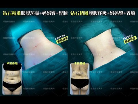 yeoncich's tweet photo. 脂肪吸引の術直後症例📸

①太もも全周＋膝内側＋ふくらはぎ
②腹部・腰まわり＋ヒップ下

術直後でもラインの変化が分かります。
腫れが落ち着くと、さらに自然でスッキリした仕上がりへ✨

#脂肪吸引 #美容整形 #深圳 https://t.co/rIiSxUdK73