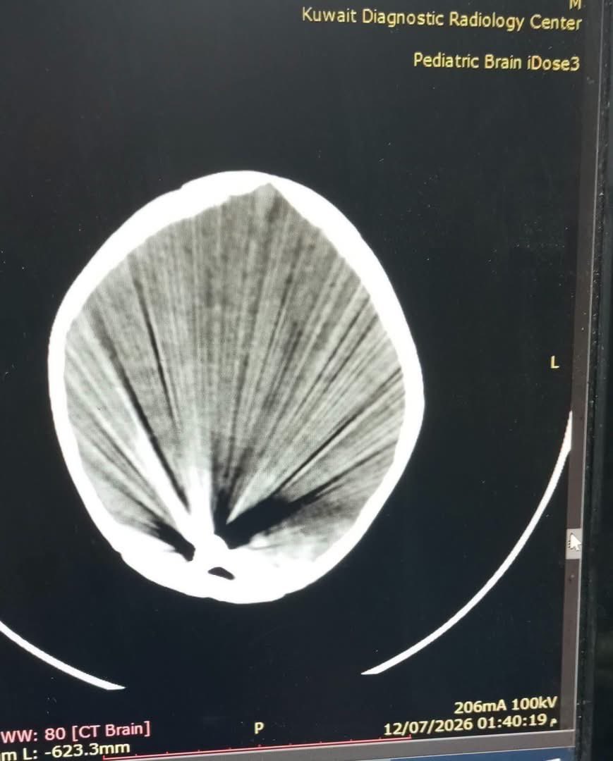 a_abdulruhman's tweet photo. In Gaza, Dr Hisham Abu Hada successfully removed a bullet from the brain of a one-year-old child.

What happened may seem like a miracle, but it is the result of doctors continuing to save lives within a healthcare system exhausted by siege, destruction, and the absence of even the most basic equipment.

Gaza’s doctors do not lack skill or courage. They lack the machines, medicines, and tools that could give many more patients another chance at life.

These doctors deserve more than our admiration. They deserve real and sustained support.