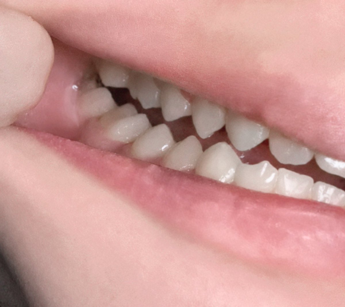 108_ioi_'s tweet photo. 私もなんだけどこれに関してはまじで食いしばり、歯ぎしり

ほんま一生口内炎と戦ってる https://t.co/xwHJfwK65c