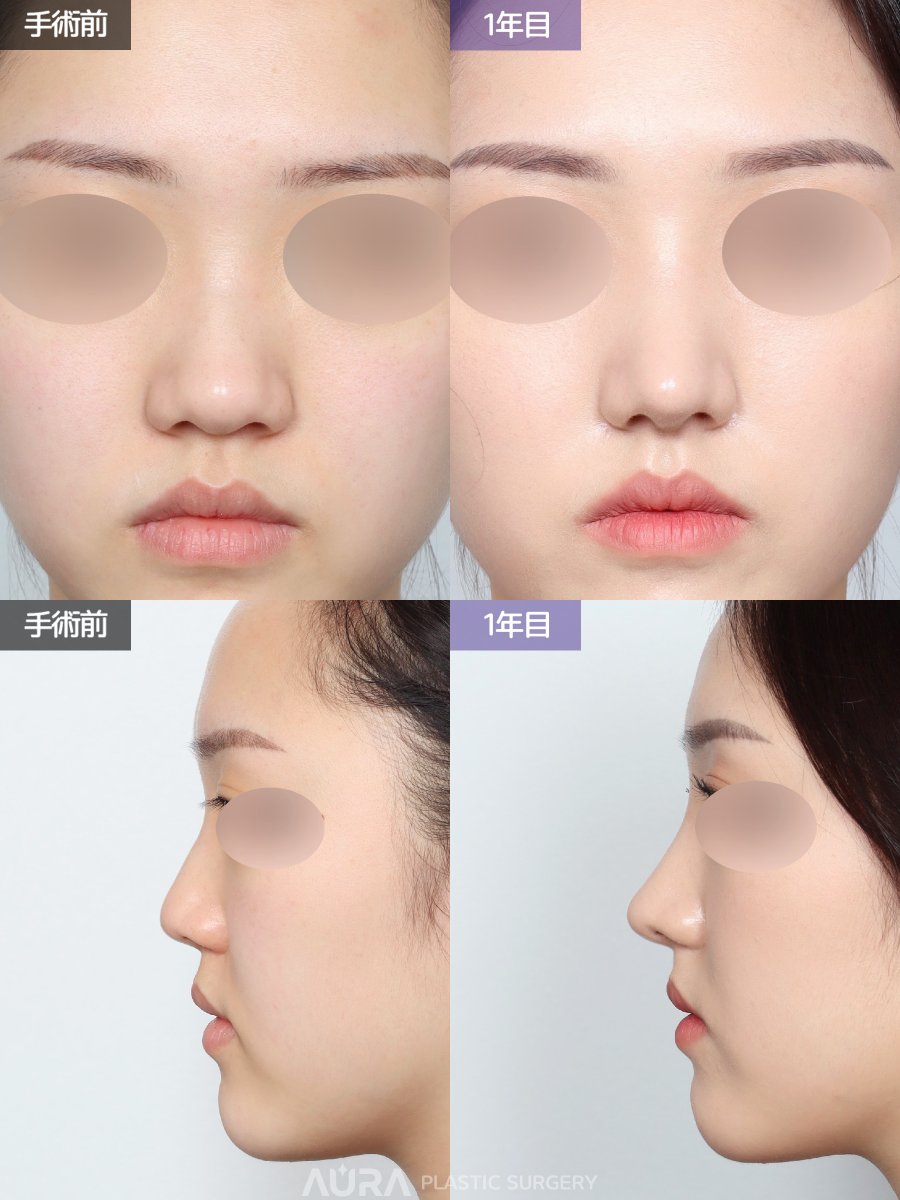 auraps2024's tweet photo. ✧ ｡ﾟ ⊹˖AURA BEFORE&AFTER ˖ ⊹ ﾟ｡ ✧

【手術内容】鼻筋＋鼻先＋骨切り幅寄せ＋鷲鼻矯正＋団子鼻矯正＋陥没鼻柱矯正＋機能鼻矯正

全体的に鼻の存在感が大きい鼻がお悩みでご来院いただいたお客様です。
正面からの印象を改善するため、団子鼻矯正と必要に応じて骨切り幅寄せを行い、鼻筋と鼻先の存在感を軽減しました。また、陥没していた鼻柱を前方に出すことで、下向き三角形の美しいACRを形成いたしました。

公式LINE：https://t.co/pMc2bkYBvU

 #韓国整形 #チュ先生 #ペク先生 #鼻初手術 #鼻再手術 #アウラ美容整形 #アウラ美容外科