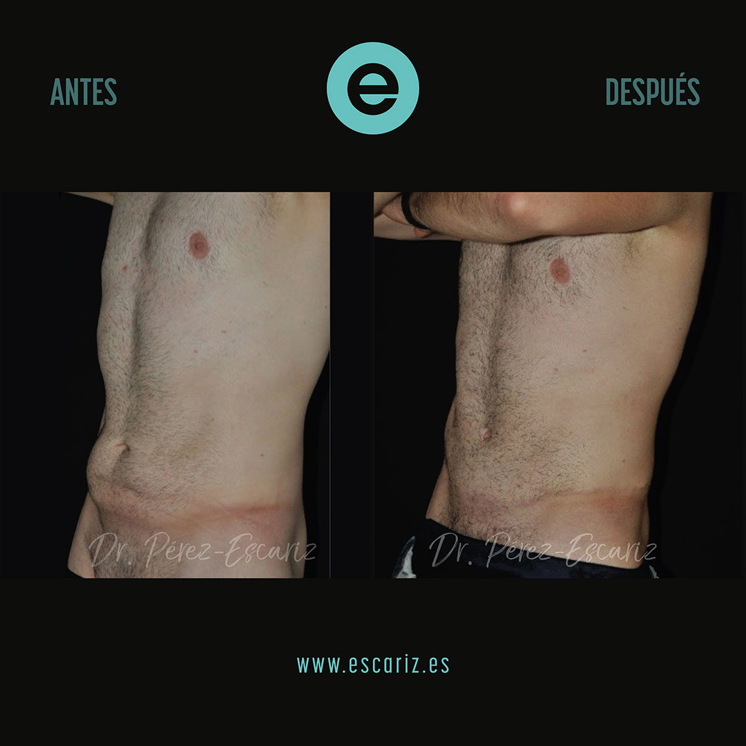 DrPerezEscariz's tweet photo. ¿Se puede recuperar el abdomen tras una gran pérdida de peso?
Realizamos una abdominoplastia con reparación de la musculatura abdominal, complementada con radiofrecuencia BodyTite y Morpheus8 para favorecer la retracción cutánea.
#DrEscariz #abdominoplastia https://t.co/lXthIvAnVL