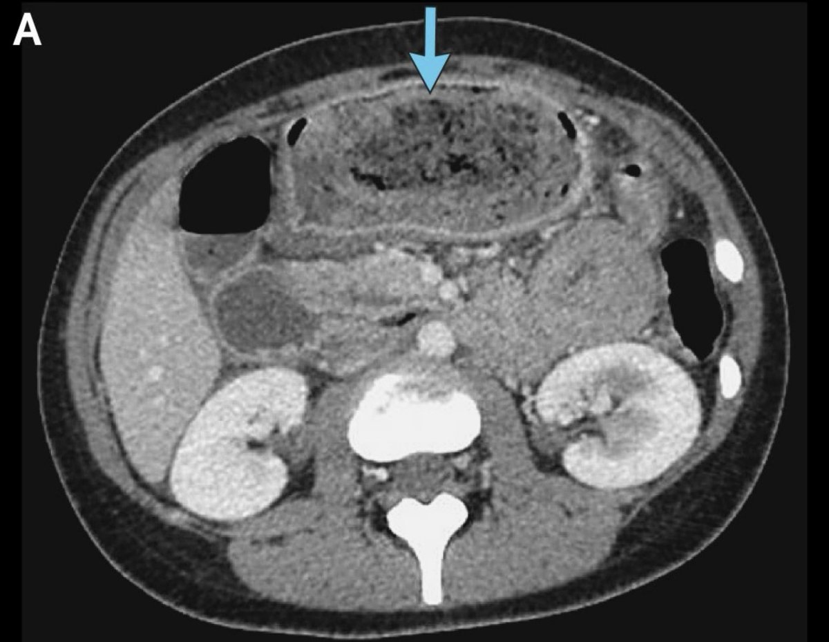 Complex's tweet photo. Doctors prescribed a 63 year-old woman 1.5 liters of Diet Coke a day after her Ozempic use contributed to a rare stomach mass. 

Two days later, her pain was gone, and the blockage had completely dissolved no surgery required; Diet Coke pulled off the miracle. https://t.co/zru8AqFipQ