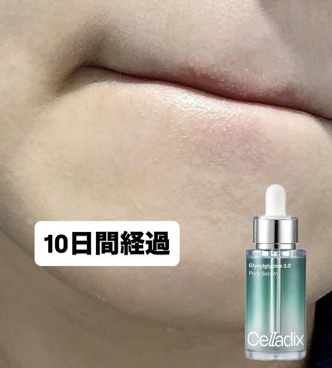late_biyou's tweet photo. まってわかんの。これ使ってから1週間で良くなってきて10日目の今これ↓皮脂ニキビさよならするから待っててね。経過あげてくよー https://t.co/RfTzUuLSjl
