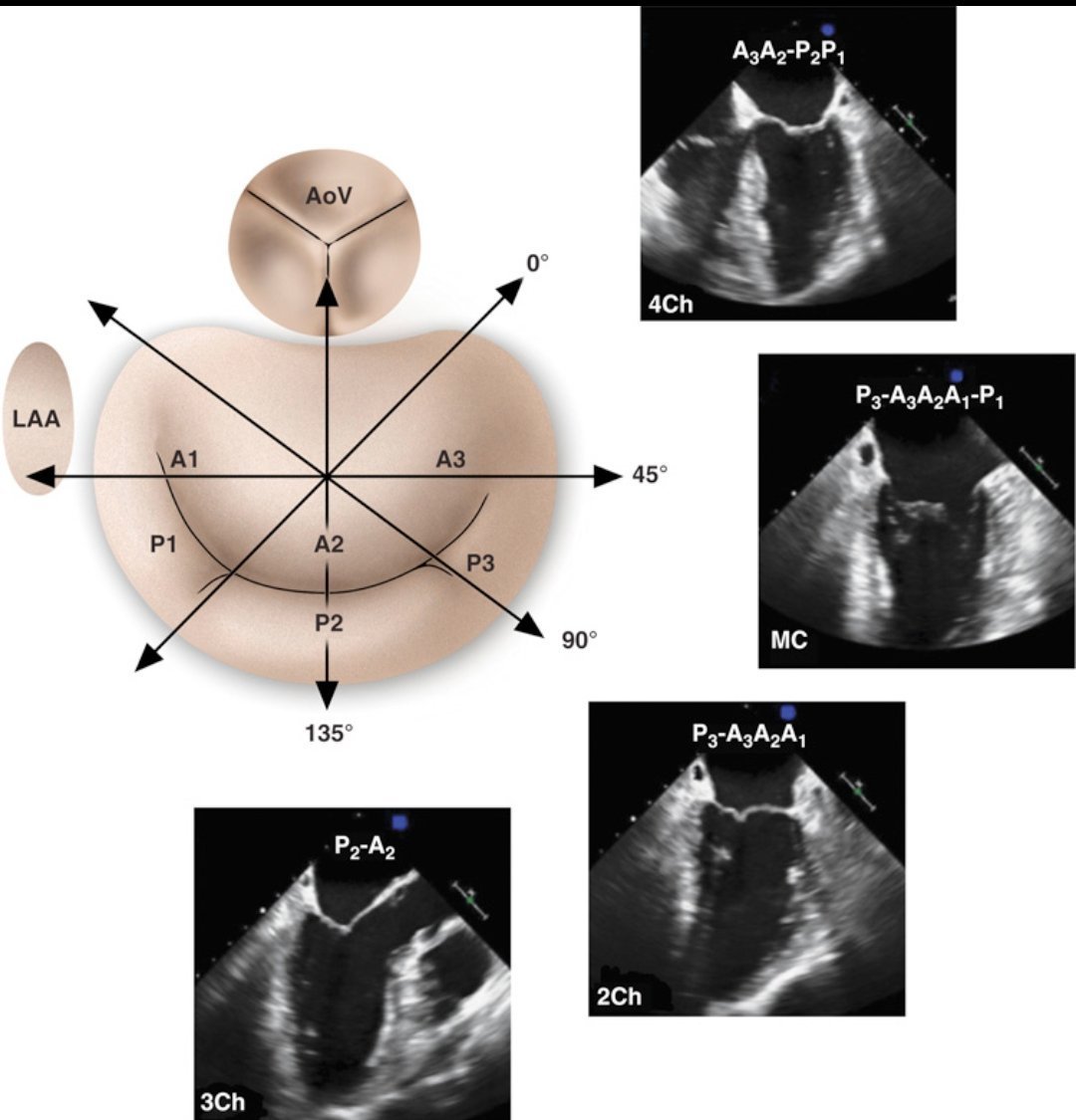 TrackYourHeart's tweet photo. Mitral Valve Anatomy in TEE!
This schematic shows the mitral valve's labeled segments with corresponding transesophageal echocardiography (TEE) views at different angles. Understanding probe positioning helps optimize imaging for structural assessment https://t.co/dyhye8yVTE