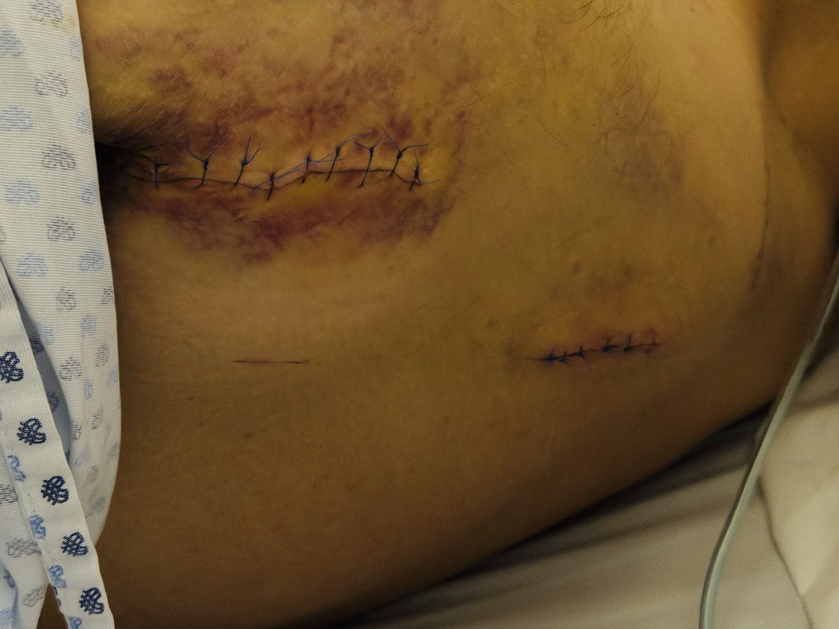 angel_dlde's tweet photo. Me llevaron a un hospital privado porque según en un público me iban a dejar morir desangrado y casualmente todas las emergencias que suceden en la alcaldía Benito Juárez llegan a este hospital, no que no iba a existir corrupcion? Ahí hay moche de las ambulancias y del hospital https://t.co/4sM3mdYcnq