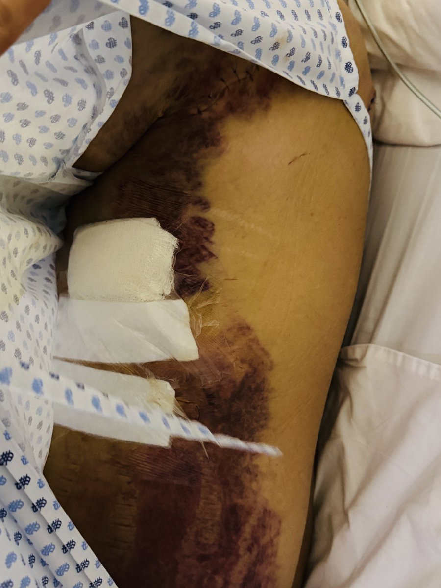 angel_dlde's tweet photo. Me llevaron a un hospital privado porque según en un público me iban a dejar morir desangrado y casualmente todas las emergencias que suceden en la alcaldía Benito Juárez llegan a este hospital, no que no iba a existir corrupcion? Ahí hay moche de las ambulancias y del hospital https://t.co/4sM3mdYcnq